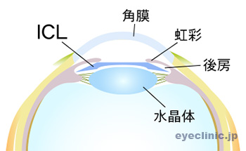 後房にICLが入っている様子