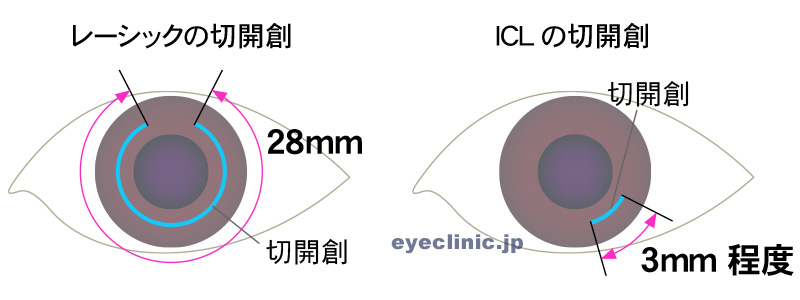 ICLの場合角膜の切開創は3mm程度